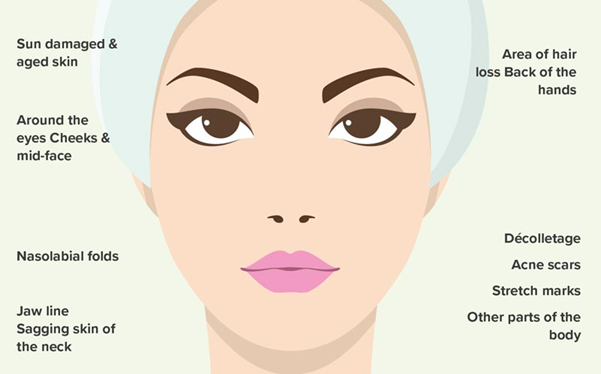 platelet rich plasma therapy